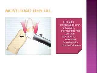  CLASE I.-
movilidad de 1mm.
 CLASE II.-
movilidad de mas
de 1mm.
 CLASE II.-
movilidad
bucolingual y
oclusoapicalmente
 