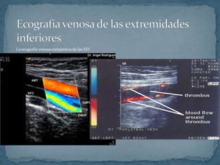 La ecografía venosa compresiva de las EEI
 