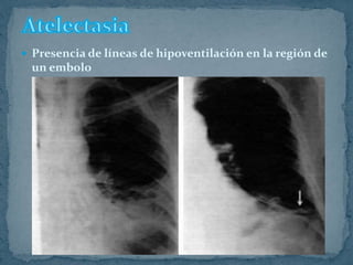  Presencia de líneas de hipoventilación en la región de
un embolo
 