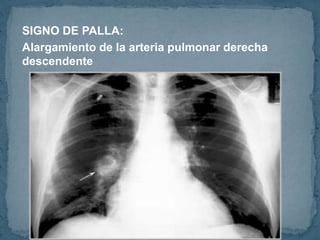 SIGNO DE PALLA:
Alargamiento de la arteria pulmonar derecha
descendente
 