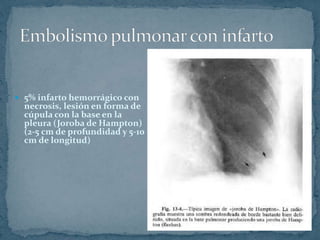  5% infarto hemorrágico con
necrosis, lesión en forma de
cúpula con la base en la
pleura (Joroba de Hampton)
(2-5 cm de profundidad y 5-10
cm de longitud)
 