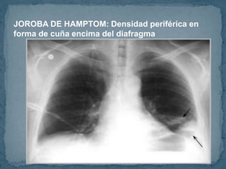 JOROBA DE HAMPTOM: Densidad periférica en
forma de cuña encima del diafragma
 