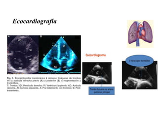 Ecocardiografía
 