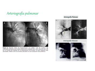 Arteriografía pulmonar
 