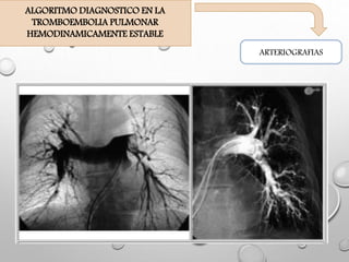 ARTERIOGRAFIAS
ALGORITMO DIAGNOSTICO EN LA
TROMBOEMBOLIA PULMONAR
HEMODINAMICAMENTE ESTABLE
 