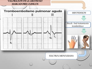 ELECTROCARDIOGRAMA
Shock / Ind tratamiento
trombolitico
VALORACION DE LA GRAVEDAD
MARCADORES CLINICOS
HIPOTENSION
 