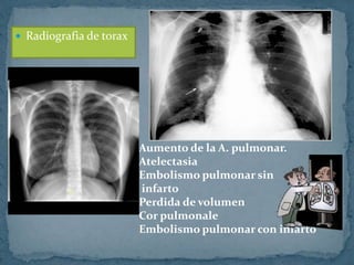  Radiografia de torax
Aumento de la A. pulmonar.
Atelectasia
Embolismo pulmonar sin
infarto
Perdida de volumen
Cor pulmonale
Embolismo pulmonar con infarto
 