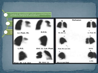 Un patrón de “alta probabilidad” combinado con probabilidad clínica
alta confirma la TEP (grado de recomendación A).
El resto de los patrones gammagráficos “no diagnósticos” o
combinaciones distintas con la probabilidad clínica no permiten
tomar decisiones definitivas (grado de recomendación A)
Actualmente la angio-TC puede sustituir a la gammagrafía pulmonar
(grado de recomendación B)
 