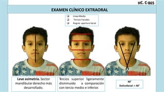 C. C-
H 865
EXAMEN CLÍNICO EXTRAORAL
Dolicofacial: < 40°
40°
Leve asimetría. Sector
mandibularderecho más
desarrollado.
Tercios superior ligeramente
disminuido a comparación
con tercio medio e inferior.
 Línea Media
 Tercios Faciales
 Ángulo apertura facial
 