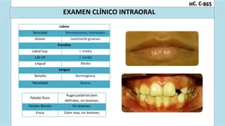 C. C-
H 865
EXAMEN CLÍNICO INTRAORAL
definidas, sin lesiones,
Paladar Duro
Rugas palatinas bien
Paladar Blando Sin lesiones.
Encía Color rosa, sin lesiones.
Labios
Tonicidad Normotónicos, hidratados.
Grosor Levemente gruesos.
Frenillos
Labial Sup. I. media
Lab Inf. I. media
Lingual Medio
Lengua
Tamaño Normoglosia.
Movilidad Buena.
 