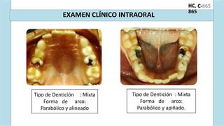 ón
a e
n
a e
. C-
HC
865
EXAMEN CLÍNICO INTRAORAL
Tipo de Dentición : Mixta
Forma de arco:
Parabólico y alineado
Tipo de Dentición : Mixta
Forma de arco:
Parabólico y apiñado.
 