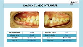 . C-
HC
865
EXAMEN CLÍNICO INTRAORAL
Relación Canina Clase I
Relación Molar Clase I
Over Bite Normal 15%
Over Jet Normal 2mm.
Relación Canina Clase I
Relación Molar Clase I
Over Bite Normal 15%
Over Jet Normal 2mm.
 