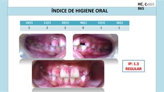 . C-
HC
865
ÍNDICE DE HIGIENE ORAL
IP: 1.3
REGULAR
16(V) 11(V) 26(V) 46(L) 31(V) 36(L)
2 2 2 0 1 1
 