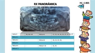 C. C-
18, 28, 4.8 NOLLA 6 17, 15, 14, 24, 25, 27, 37, 3
38 NOLLA 7 13, 23, 34, 33, 43, 44.
- NOLLA 8 16, 12, 22, 26,
- NOLLA 9 11, 21, 36, 32, 42, 46
- NOLLA 10 31, 41
47 Observaciones: -
H 865
RX PANORÁMICA
Nolla 0 5, 47
NOLLA 1
NOLLA 2
NOLLA 3
NOLLA 4
NOLLA 5
 