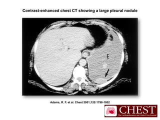 Adams, R. F. et al. Chest 2001;120:1798-1802
Contrast-enhanced chest CT showing a large pleural nodule
 