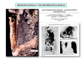 MESOTELIOMAS Y SEUDOMESOTELIOMAS
 