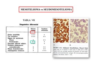 MESOTELIOMA vs SEUDOMESOTELIOMA
 
