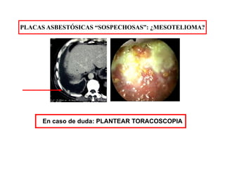 PLACAS ASBESTÓSICAS “SOSPECHOSAS”: ¿MESOTELIOMA?
En caso de duda: PLANTEAR TORACOSCOPIA
 