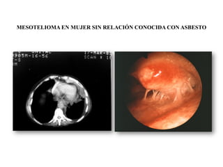 MESOTELIOMA EN MUJER SIN RELACIÓN CONOCIDA CON ASBESTO
 