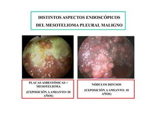 DISTINTOS ASPECTOS ENDOSCÓPICOS
DEL MESOTELIOMA PLEURAL MALIGNO
PLACAS ASBESTÓSICAS +
MESOTELIOMA
(EXPOSICIÓN AAMIANTO>30
AÑOS)
NÓDULOS DIFUSOS
(EXPOSICIÓN AAMIANTO: 18
AÑOS)
 