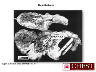 Cugell, D. W. et al. Chest 2004;125:1103-1117
Mesothelioma
 