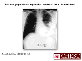 Monnet, I. et al. Chest 2002;121:1921-1927
Chest radiograph with the implantable port related to the pleural catheter
 