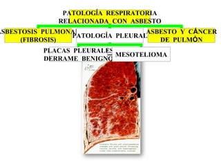 PATOLOGÍA RESPIRATORIA
RELACIONADA CON ASBESTO
ASBESTOSIS PULMONAR
(FIBROSIS)
PATOLOGÍA PLEURAL
ASBESTO Y CÁNCER
DE PULMÓN
PLACAS PLEURALES
DERRAME BENIGNO
MESOTELIOMA
 