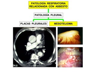PLACAS PLEURALES MESOTELIOMA
PATOLOGÍA PLEURAL
PATOLOGÍA RESPIRATORIA
RELACIONADA CON ASBESTO
 