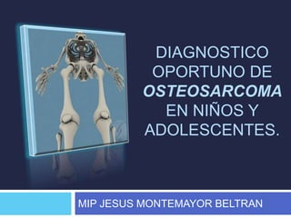 DIAGNOSTICO 
OPORTUNO DE 
OSTEOSARCOMA 
EN NIÑOS Y 
ADOLESCENTES. 
MIP JESUS MONTEMAYOR BELTRAN 
 