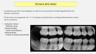  La película, que tiene una lengüeta, se coloca en una posición comida lingualmente a los
dientes a examinar.
 El haz toma una angulación de +7 a 10 grados verticalmente y se dirige directamente a través
de los contactos.
TÉCNICA BITE WING
• Indicación clínica:
- Detectar caries
interproximales.
- Caries secundarias a
restauraciones.
- Evaluar el estado periodontal.
 