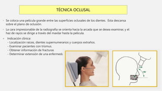• Se coloca una película grande entre las superficies oclusales de los dientes. Esta descansa
sobre el plano de oclusión.
• La cara impresionable de la radiografia se orienta hacia la arcada que se desea examinar, y el
haz de rayos se dirige a través del maxilar hasta la película.
 Indicación clínica:
- Localización raíces, dientes supernumerarios y cuerpos extraños.
- Examinar pacientes con trismus.
- Obtener información de fracturas
- Determinar extensión de una enfermedad.
TÉCNICA OCLUSAL
 