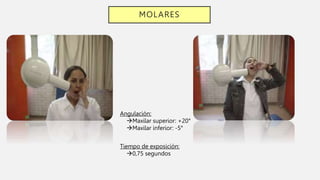 MOLARES
Angulación:
Maxilar superior: +20°
Maxilar inferior: -5°
Tiempo de exposición:
0,75 segundos
 