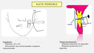 ALETA MORDIBLE
Angulación:
Vertical: +8° a 10°
Horizontal: rayo central paralelo a espacios
interproximales
Tiempo de exposición:
Dientes anteriores: 0,5 segundos
Dientes posteriores: 0,75
segundos
 