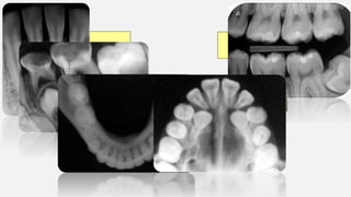 TIPOS DE RADIOGRAFÍAS INTRAORALES
Interproximal o aleta mordible
Oclusales
Periapicales o dentoalveolar
 