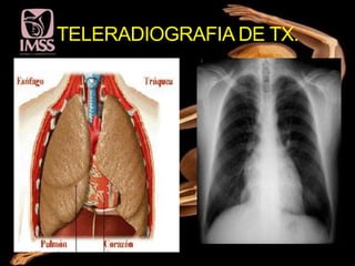 TELERADIOGRAFIA DE TX.
 