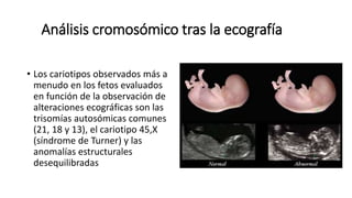 Análisis cromosómico tras la ecografía
• Los cariotipos observados más a
menudo en los fetos evaluados
en función de la observación de
alteraciones ecográficas son las
trisomías autosómicas comunes
(21, 18 y 13), el cariotipo 45,X
(síndrome de Turner) y las
anomalías estructurales
desequilibradas
 