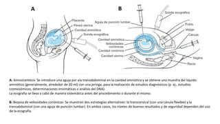 A: Amniocentesis. Se introduce una aguja por vía transabdominal en la cavidad amniótica y se obtiene una muestra del líquido
amniótico (generalmente, alrededor de 20 ml) con una jeringa, para la realización de estudios diagnósticos (p. ej., estudios
cromosómicos, determinaciones enzimáticas o análisis del DNA).
La ecografía se lleva a cabo de manera sistemática antes del procedimiento o durante el mismo.
B: Biopsia de vellosidades coriónicas. Se muestran dos estrategias alternativas: la transcervical (con una cánula flexible) y la
transabdominal (con una aguja de punción lumbar). En ambos casos, los niveles de buenos resultados y de seguridad dependen del uso
de la ecografía.
 