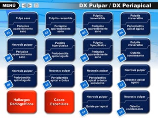 Necrosis pulpar
Quiste periapical
Necrosis pulpar
Osteítis
condensante
Necrosis pulpar
Periodontitis
apical aguda
Necrosis pulpar
Periodontitis
apical crónica
Necrosis pulpar
Periodontitis
apical crónica
supurativa
Necrosis pulpar
Absceso apical
agudo
Necrosis pulpar
Periapice
aparentemente
sano
Pulpitis
hiperplásica
Periodontitis
apical aguda
MENÚ
Pulpitis
hiperplásica
Periapice
aparentemente
sano
Pulpitis reversible
Periapice
aparentemente
sano
Pulpa sana
Periapice
aparentemente
sano
Pulpitis
irreversible
Periapice
aparentemente
sano
Pulpitis
irreversible
Periodontitis
apical aguda
Pulpitis
irreversible
Osteítis
condensante
Casos
Especiales
Hallazgos
Radiográficos
DX Pulpar / DX Periapical
 