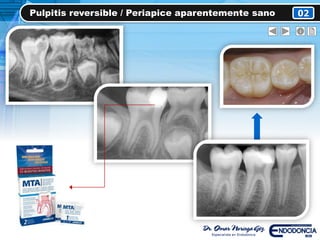 Pulpitis reversible / Periapice aparentemente sano 02
 