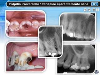 Pulpitis irreversible / Periapice aparentemente sano 03
 