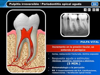 Pulpitis irreversible / Periodontitis apical aguda 04
• PULPA VITAL
• Inflamación irreversible
del tej. Pulpar y periapical
• Caries, restauración fracturada, dentina expuesta
• Respuesta aguda a estímulos:
Térmicos, osmóticos, mecánicos y eléctricos.
(5 MIN.)
• Sintomatología a la percusión
• RX  Ensanchamiento del ELP, Calcificaciones,
reabsorciones / Rarefacción apical inicial.
Incremento en la presión tisular, se
extiende al periápice
 