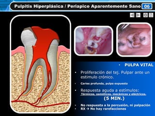 • PULPA VITAL
• Proliferación del tej. Pulpar ante un
estimulo crónico.
• Caries profunda, pulpa expuesta
• Respuesta aguda a estímulos:
Térmicos, osmóticos, mecánicos y eléctricos.
(5 MIN.)
• No respuesta a la percusión, ni palpación
• RX  No hay rarefacciones
Pulpitis Hiperplásica / Periapice Aparentemente Sano 06
 