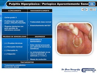 Pulpitis Hiperplásica / Periapice Aparentemente Sano 06
CLÍNICAMENTE RADIOGRÁFICAMENTE
• Caries grado 3
• Proliferación del tejido
pulpar (PÓLIPO PULPAR)
• Órganos dentarios con
gran perdida de
estructura coronal.
• Trabeculado óseo normal
• Ensanchamiento del ELP
PRUEBAS DE SENSIBILIDAD ANAMNESIS
• (+) Pruebas térmicas
• (-) Percusión Vertical
• (-) Percusión H.
• (-) Palpación
• Sintomático o
Asintomático
• Dolor dental provocado
por estímulos térmicos y
osmóticos
• La sintomatología no se
retira al eliminar el
estimulo (+ 5 min.)
• Meses de evolución
TRATAMIENTOS
• Tratamiento endodóntico
• Extracción dental
 