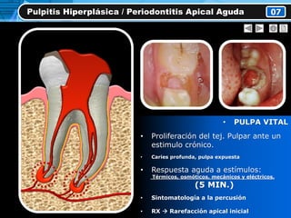 • PULPA VITAL
• Proliferación del tej. Pulpar ante un
estimulo crónico.
• Caries profunda, pulpa expuesta
• Respuesta aguda a estímulos:
Térmicos, osmóticos, mecánicos y eléctricos.
(5 MIN.)
• Sintomatología a la percusión
• RX  Rarefacción apical inicial
Pulpitis Hiperplásica / Periodontitis Apical Aguda 07
 