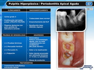 Pulpitis Hiperplásica / Periodontitis Apical Aguda 07
CLÍNICAMENTE RADIOGRÁFICAMENTE
• Caries grado 3
• Proliferación del tejido
pulpar (PÓLIPO PULPAR)
• Órganos dentarios con
gran perdida de
estructura coronal.
• Trabeculado óseo normal
• Ensanchamiento del ELP
• Rarefacción ósea
INICIAL (Apical)
PRUEBAS DE SENSIBILIDAD ANAMNESIS
• (+) Pruebas térmicas
• (+) Percusión Vertical
• (+) Percusión H.
• (-) Palpación
• Sintomático
• Refiere sintomatología
aguda, que no sede
completamente con
analgésicos
(No pudo dormir)
• Dolor a la masticación
• Dolor dental provocado
por estímulos térmicos
(> 5 min.) y osmóticos
• Meses de evolución
TRATAMIENTOS
• Tratamiento endodóntico
• Extracción dental
 