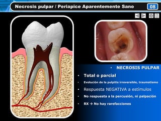 • NECROSIS PULPAR
• Total o parcial
• Evolución de la pulpitis irreversible, traumatismo
• Respuesta NEGATIVA a estímulos
• No respuesta a la percusión, ni palpación
• RX  No hay rarefacciones
Necrosis pulpar / Periapice Aparentemente Sano 08
 