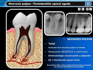 • NECROSIS PULPAR
• Total
• Evolución de la necrosis pulpar no tratada
• Respuesta NEGATIVA a estímulos
• Sintomatología a la percusión y palpación
• RX  Rarefacción apical inicial
Se produce dolor como consecuencia del gran aumento
de presión hidrostática de los tejidos
Necrosis pulpar / Periodontitis apical aguda 09
 