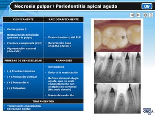 Necrosis pulpar / Periodontitis apical aguda 09
CLÍNICAMENTE RADIOGRÁFICAMENTE
• Caries grado 3
• Restauración deficiente
(próxima a la pulpa)
• Fractura complicada (EDP)
• Pigmentación coronal
(Gris-Café)
• Ensanchamiento del ELP
• Rarefacción ósea
INICIAL (Apical)
PRUEBAS DE SENSIBILIDAD ANAMNESIS
• (-) Pruebas térmicas
• (+) Percusión Vertical
• (+) Percusión H.
• (+) Palpación
• Sintomático
• Dolor a la masticación
• Refiere sintomatología
aguda, que no sede
completamente con
analgésicos comunes
(No pudo dormir)
• Meses de evolución
TRATAMIENTOS
• Tratamiento endodóntico
• Extracción dental
 