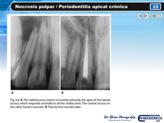 Necrosis pulpar / Periodontitis apical crónica 10
 