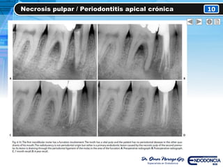 Necrosis pulpar / Periodontitis apical crónica 10
 